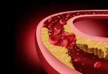 Koncept zablokované lidské tepny a omezený průtok krve v tepnách a cévách jako nemoc s nahromaděným cholesterolem